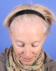 Before Hair Transplant&nbsp;Hair Thinning